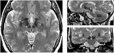 Unilateral Stimulation of Subthalamic Nucleus Does Not Affect Inhibitory Control